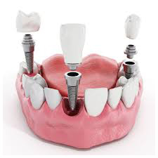 Этапы проведения имплантации зубов