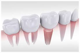 Виды имплантации зубов