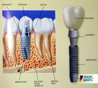 Имплантация зубов без разреза десны