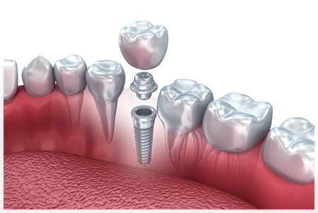 Импланты зубов