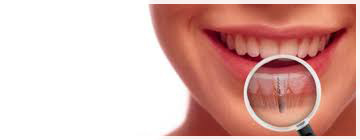 Синус лифтинг - использование при имплантации зубов