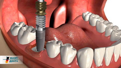Бескровная имплантация зубов