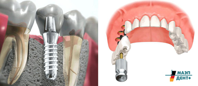 Полная имплантация зубов верхней челюсти