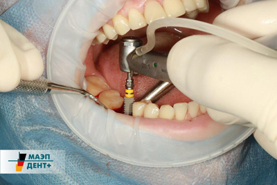 Установка имплантов зубов