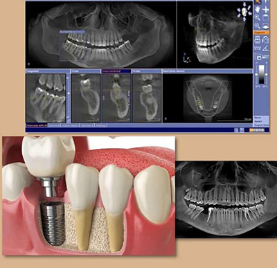 Имплантация зубов возможные осложнения